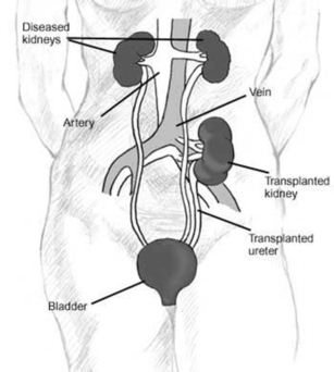 Access-Nephrology-Kidney-Transplant2